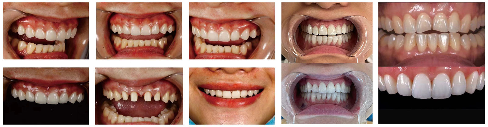 Coroas de implante de laboratório dentário