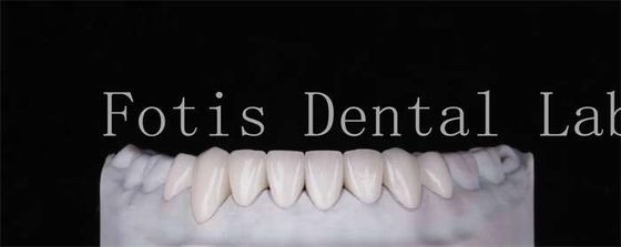 Alta Durabilidade Veneers Dentes de aparência natural 0,3 mm-0,5 mm espessura
