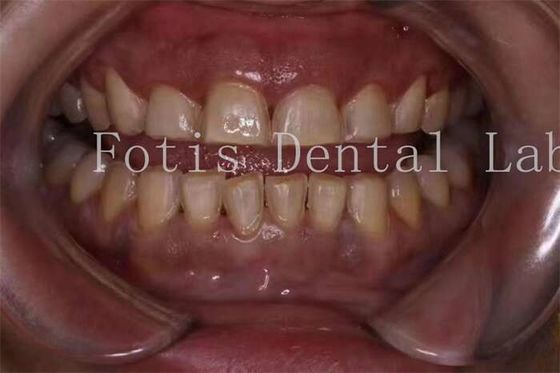 Fabricação de veneers de porcelana para dentes com textura suave