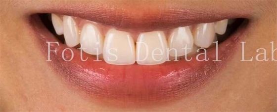 Beneficios para os dentes para a resistência perfeita às manchas do sorriso
