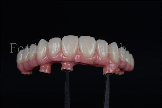 Restauração da capacidade de mastigar com 4 ou 6 implantes