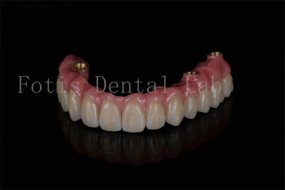 Restauração de arco completo todos em quatro implantes para o melhor desempenho do implante dental
