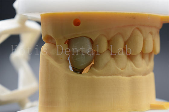 Implante Dental Personalizavel Coroa Abutment Confortável Para Pacientes