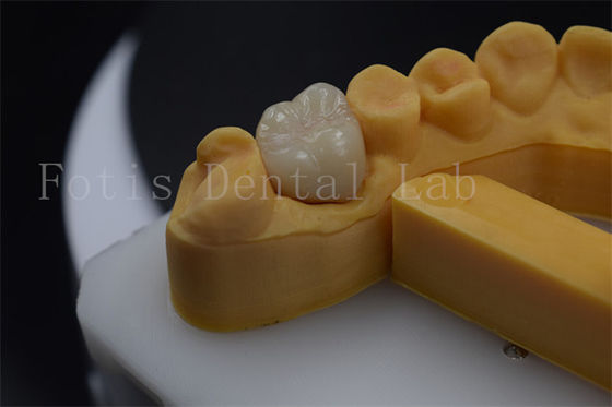 Titânio / PFM Prótese de coroa Customizable Zirconia Implante de coroa Durável