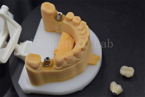 Fácil de colocar coroas de dentes de zircônio coroas de titânio para dentes personalizadas