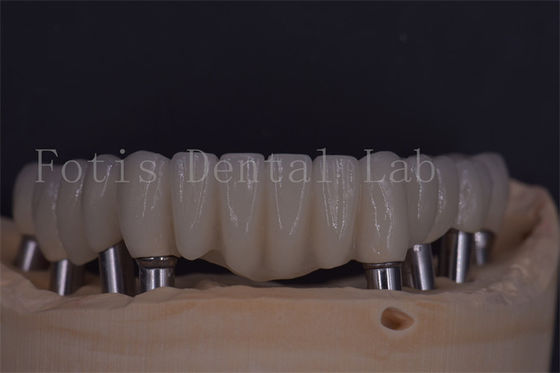 Coroas de implante dentário confiáveis para conforto e funcionalidade