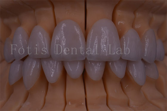 FDA/ISO/CE Certificado Dentes de coroa digital Coroa artificial de qualquer tamanho