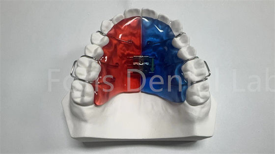 Expansor Ortodôntico Individual para Correção e Melhoria Dental