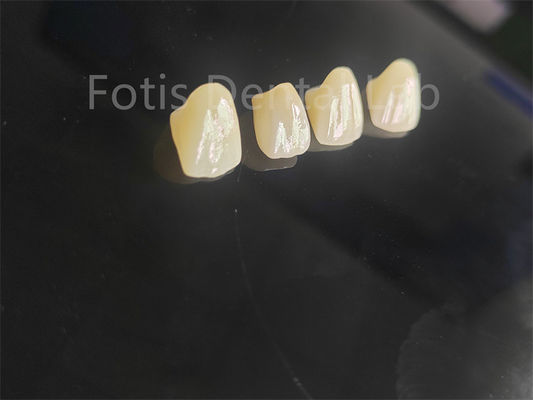 Porcelana de qualidade profissional Zirconia fundida para restaurações dentárias perfeitamente ajustadas