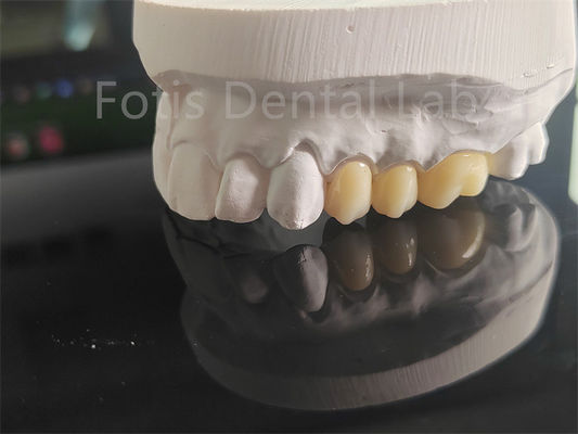 Circônio em camadas de porcelana de alta resistência para coroas dentárias