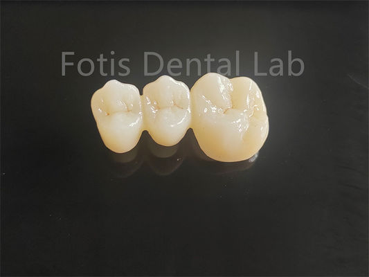 Circônio em camadas de porcelana de alta resistência para pontes dentárias duradouras