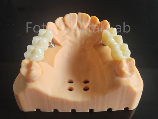 Circonia de contorno completo personalizada com camadas de material dental de porcelana
