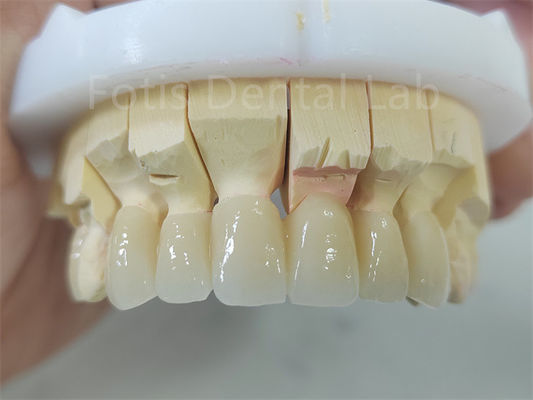Produto Dentário Zirconia em camadas com porcelana Fácil manutenção