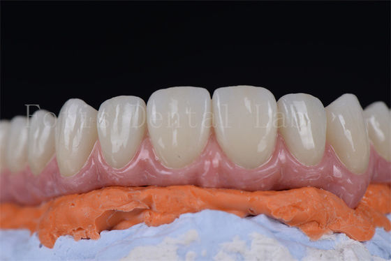 comprar Inovador, minimamente invasivo, todos em 4 todos em 6 implantes dentários em 1-2 semanas. online manufacture