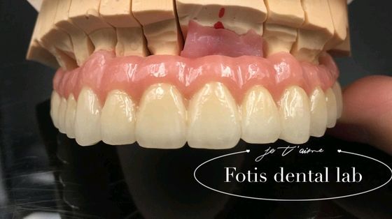 Restauração confiável PFM coroas dentárias de porcelana fundida a coroa de metal personalizada