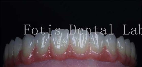 Superfície lisa Revestimentos dentários cosméticos Veneers de porcelana natural personalizáveis