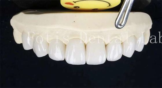 0.3-0.5mm Dentes de cerâmica laminada Veneers de dentes falsos com cimento adesivo de ligação