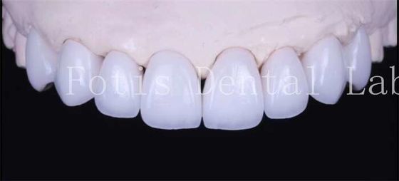 Cimento adesivo de ligação Veneers brancos naturais com alta translucidez