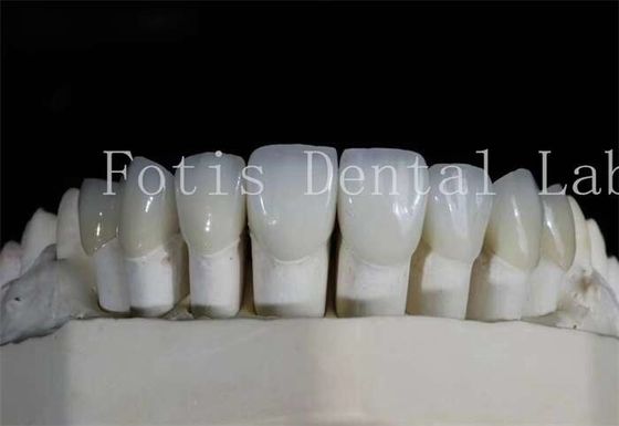 Veneers de laminado dentário polido de alta translucidez para sorrisos de aparência natural