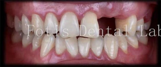 Folhas dentárias temporárias naturais personalizadas para um sorriso bonito