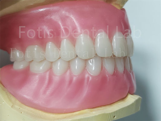 Dentes Ivoclares Prótese Dentária Acrílica Completa Fácil de Limpeza Alta Durabilidade