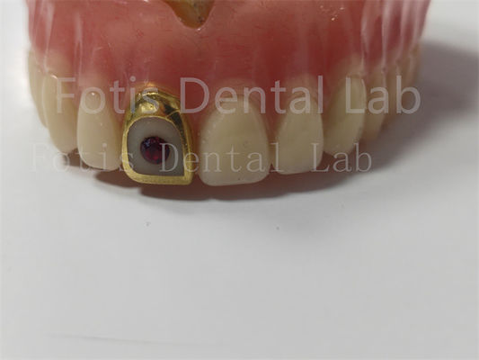 Prótese dental acrílica completa confortável para profissionais Resistente a manchas / cheiros
