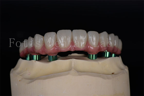 Titânio/Zircônio de longa duração Todos em 4/6 Implantes Fácil manutenção Alta taxa de sucesso