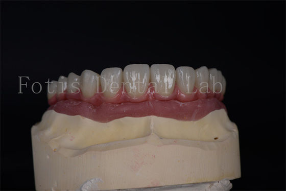 Estética Natural com Implantes Todos em 4 e Todos em 6