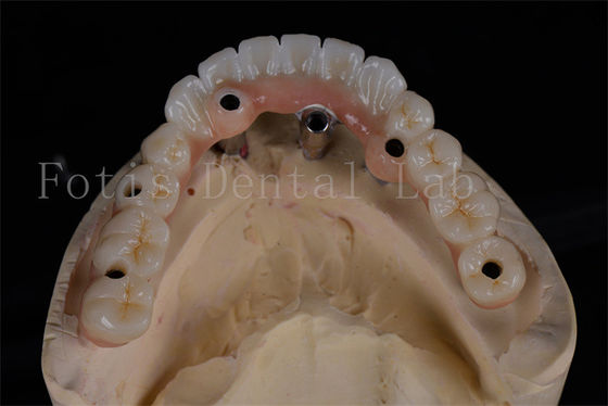 Taxa de sucesso Implantes dentários todos-em-quatro Procedimento no mesmo dia Acessível Restauração completa da mastigação