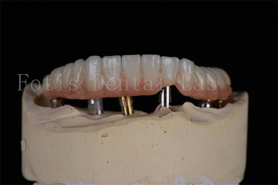Acessível Aparência natural 4 ou 6 implantes de arco completo Taxa de sucesso Solução minimamente invasiva