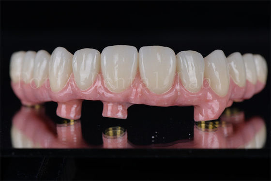 Implantes Dentários Individual Todos em 4 Todos em 6 Restaura a plena capacidade de mastigar