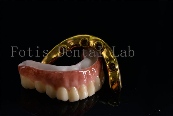 Implantes Dentários Todos em Seis de preço acessível Tratamento eficaz Fácil de limpar