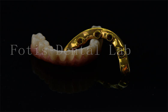 Titânio Zircônio Todos em 4 Todos em 6 Implantes Sorriso Completo Implantes Garantia vitalícia