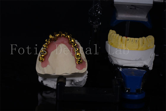 Implantes dentários de titânio / zircônio todos em 4 para sorrisos naturais