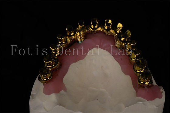 Natural olhando tudo em 4 tudo em 6 Implantes dentários restaurar a capacidade de mastigar completa