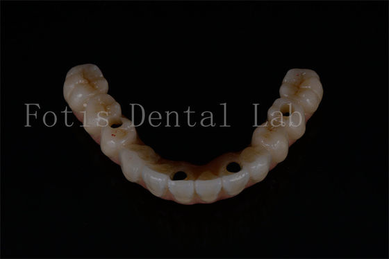 Substituição de implantes dentários avançados para função ideal