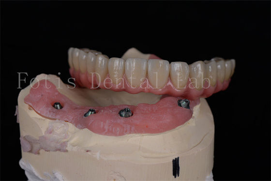 Implantes dentários personalizáveis para reabilitação oral completa