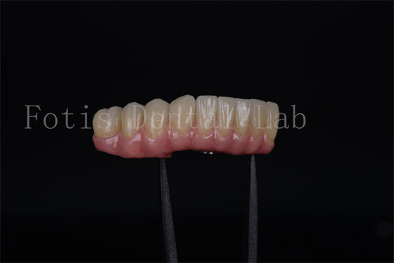 Rápido e eficaz todos em quatro todos em seis em um dia Implantes segurança garantida