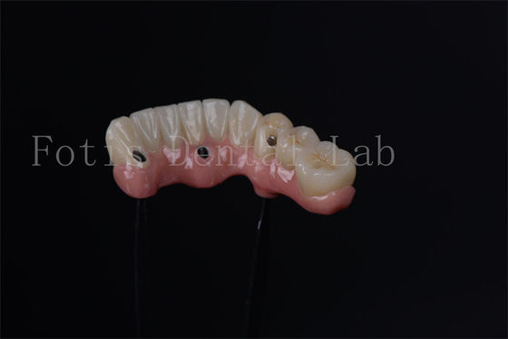 Implantes endostáticos individuais para substituição imediata de dentes
