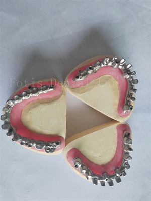 Personalizado All On 4 All On 6 A solução perfeita para restaurações de implantes dentários