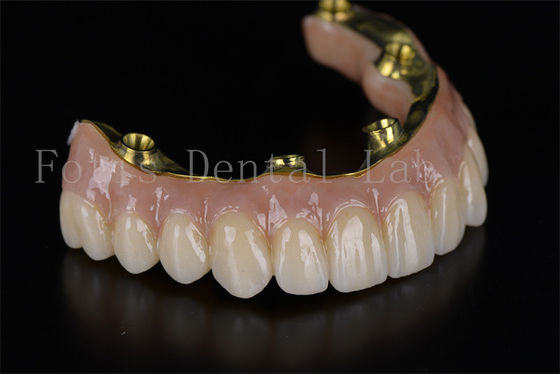 Reconstrução da Boca Completa Sistema de Implantes Dentários All On 4 All On 6