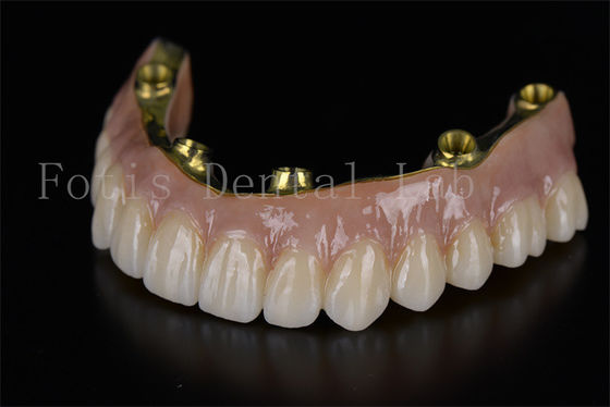 Restauração de arco completo, implantes todos em seis, solução minimamente invasiva.