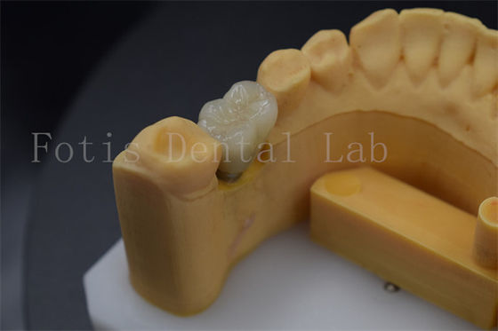 Coroas de implante dental confortáveis e duradouras para restauração de dentes perdidos