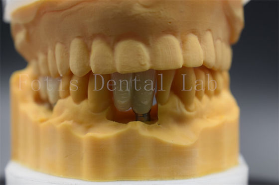 Coroa de Implante Dental de Precisão Feita sob Encomenda Adequada para Dentes Faltantes
