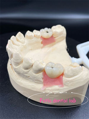Customização Titânio/Zicônia/PFM Coroas Dentárias de Laboratório Confortáveis