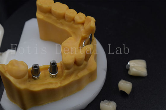 Coroa de implante dentário de alta durabilidade fácil de ajustar Guia de mangas de implante dentário
