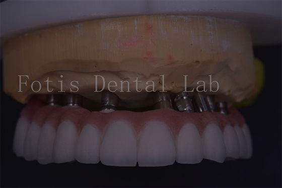 Coroa dental de prata personalizável de precisão adequada para restauração confortável