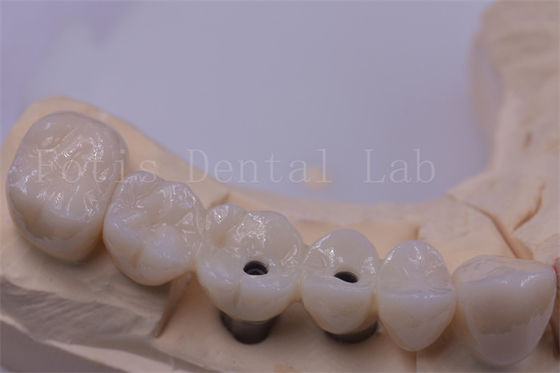 Titânio / Circônio coroa dental prata polida para dentes ausentes