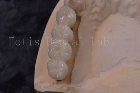Implante de coroa de dente de zircônia de precisão PFM coroa fácil de limpar