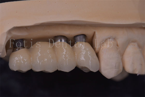 Coronas de implantes dentários de ajuste preciso Titânio / Zircônio / PFM Restauração de dentes perdidos